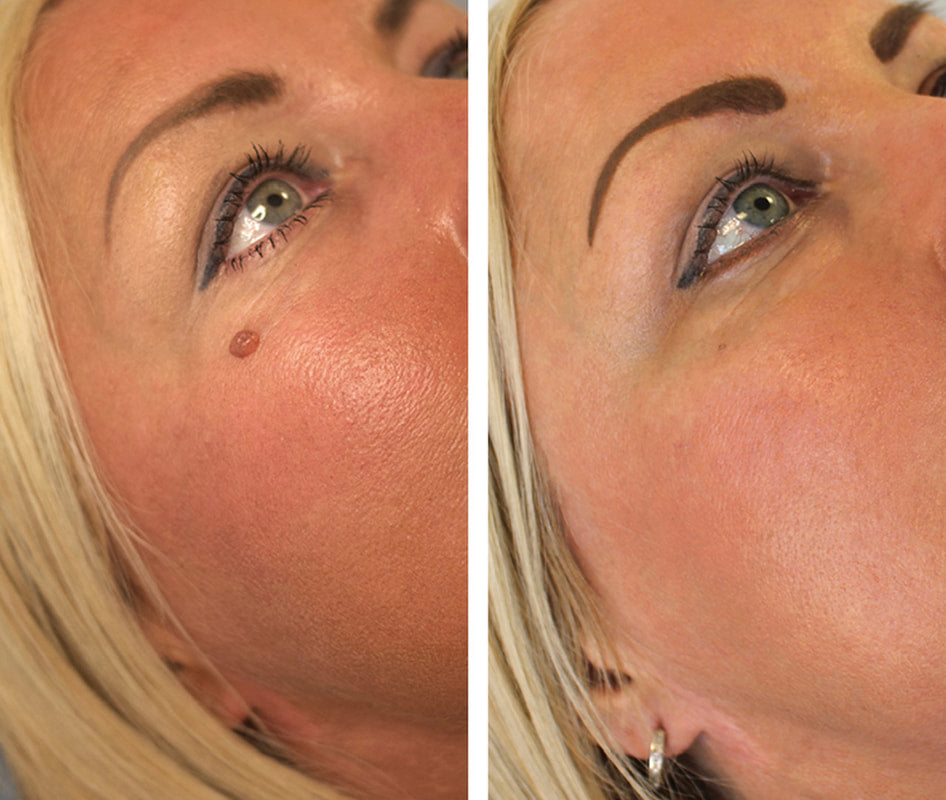 SkinTag - Snabb och smÀrtfri hudflikborttagning hemma